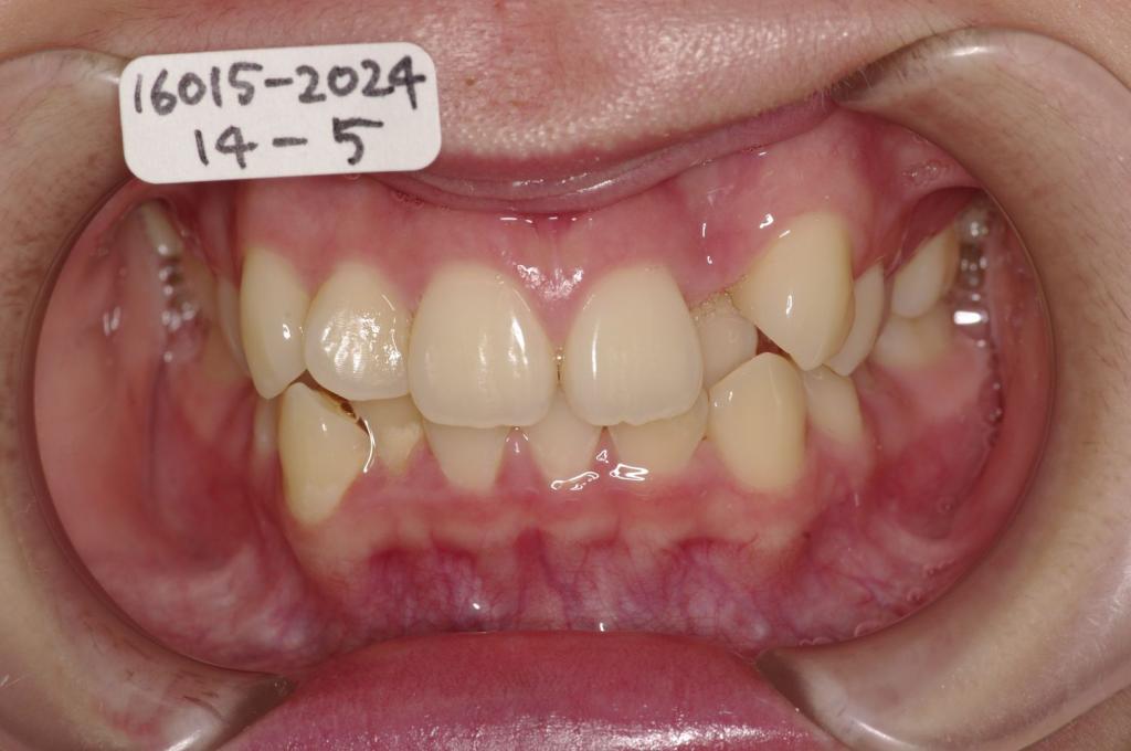 歯並び・咬み合わせ・八重歯・乱杭歯の矯正治療前口内写真NO.1227