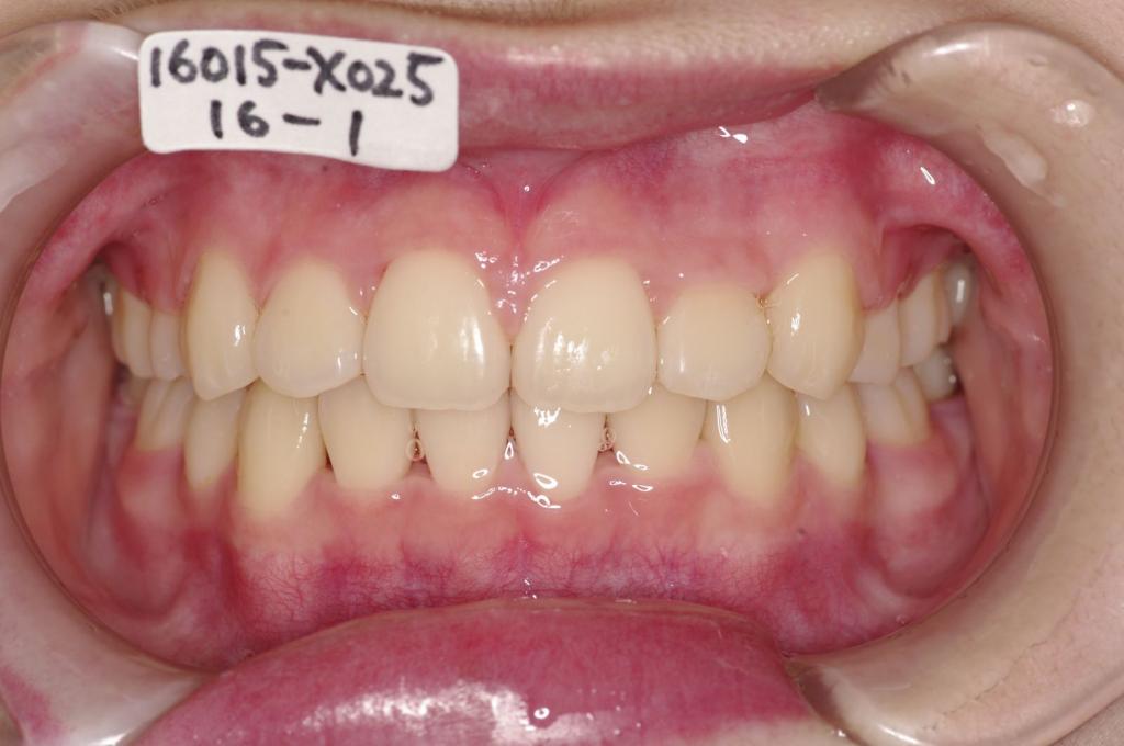 歯並び・咬み合わせ・八重歯・乱杭歯の矯正治療後口内写真NO.1227