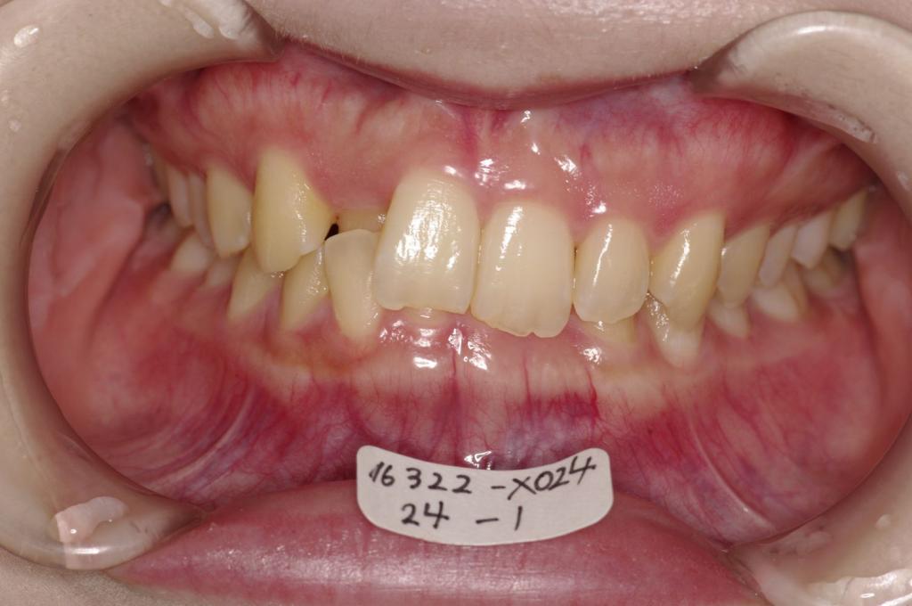 歯並び・咬み合わせ・八重歯・乱杭歯の矯正治療前口内写真NO.1228