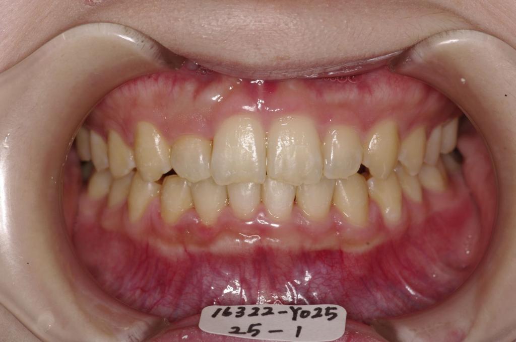 歯並び・咬み合わせ・八重歯・乱杭歯の矯正治療後口内写真NO.1228