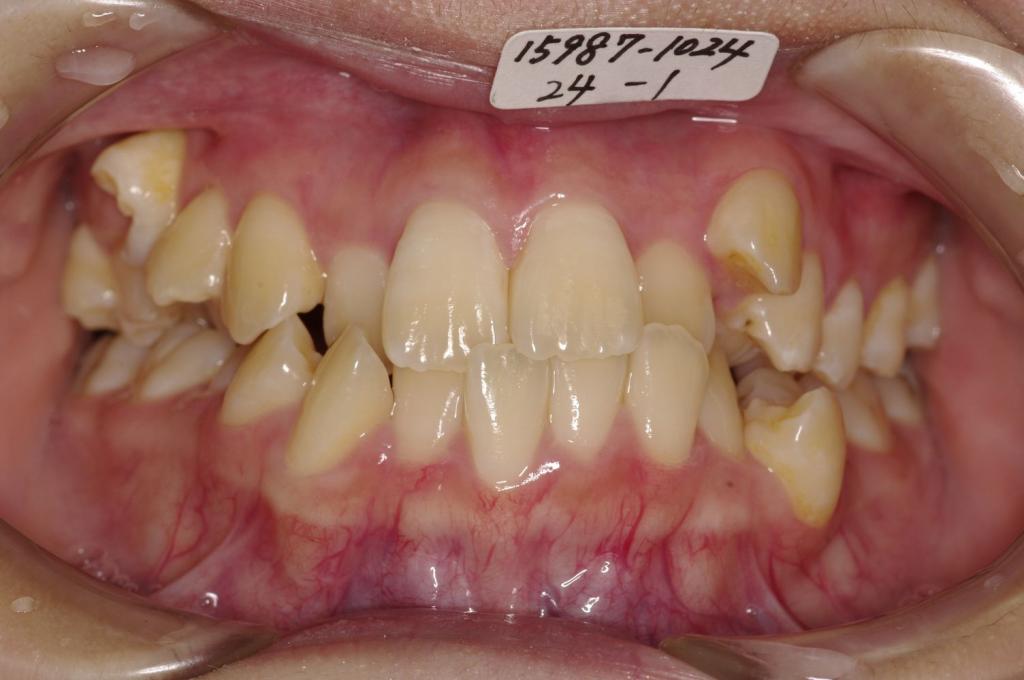 歯並び・咬み合わせ・八重歯・乱杭歯の矯正治療前口内写真NO.1229