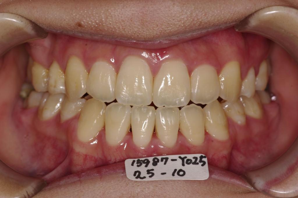 歯並び・咬み合わせ・八重歯・乱杭歯の矯正治療後口内写真NO.1229