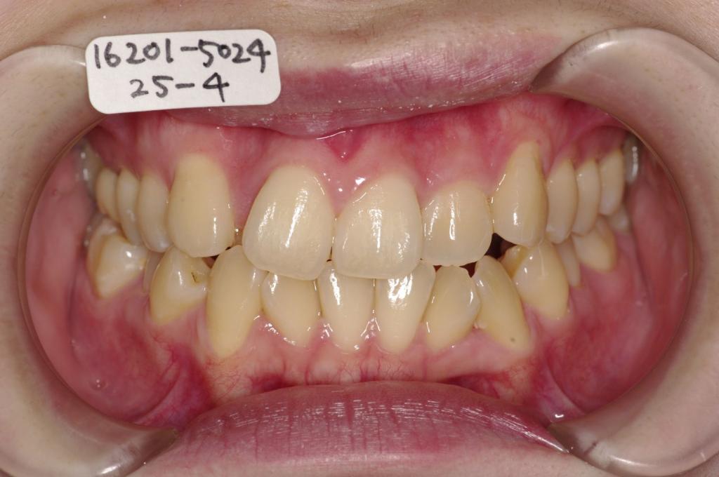 歯並び・咬み合わせ・八重歯・乱杭歯の矯正治療前口内写真NO.1230