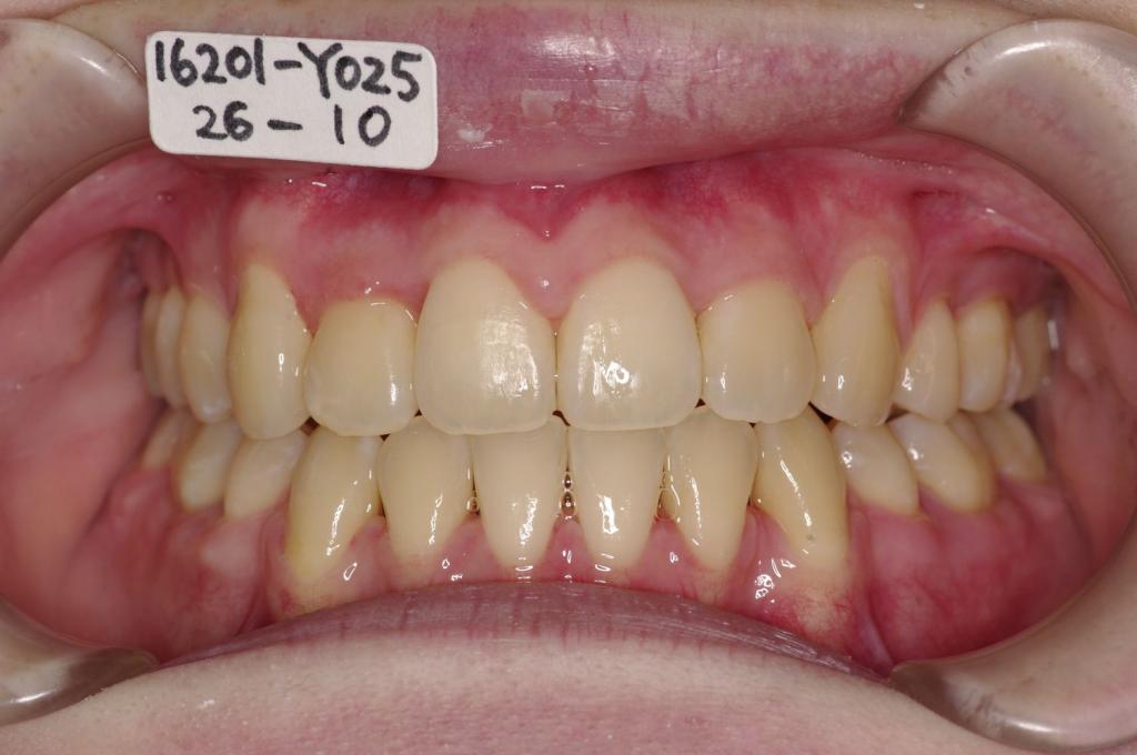 歯並び・咬み合わせ・八重歯・乱杭歯の矯正治療後口内写真NO.1230