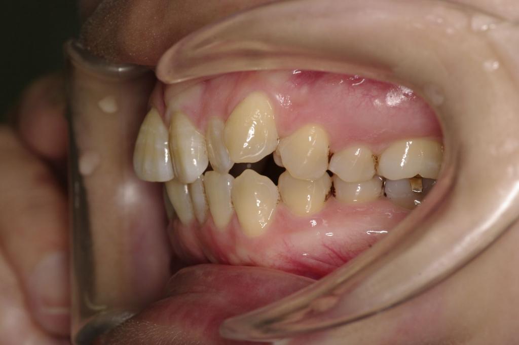 歯並び・咬み合わせ・八重歯・乱杭歯の矯正治療前口内写真NO.1231