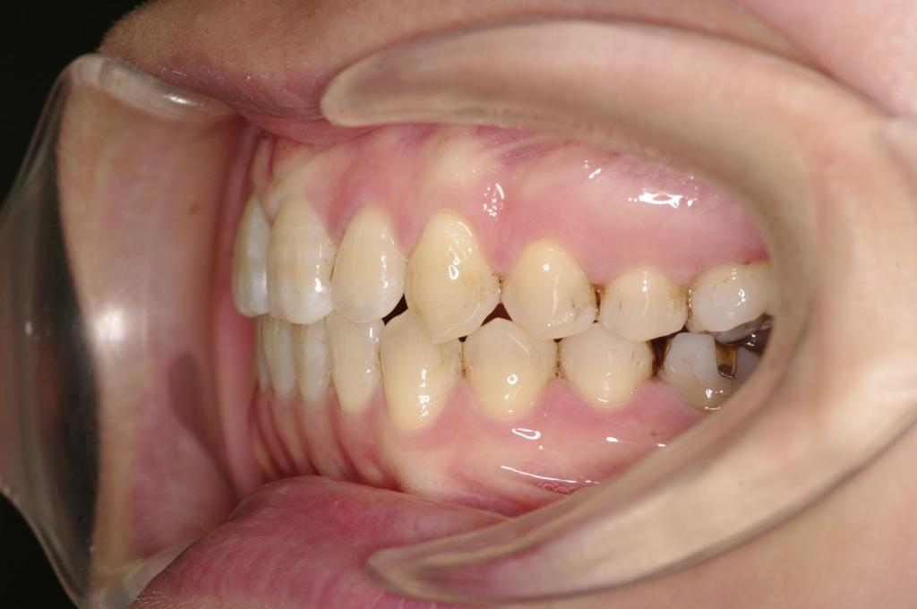 歯並び・咬み合わせ・八重歯・乱杭歯の矯正治療後口内写真NO.1231