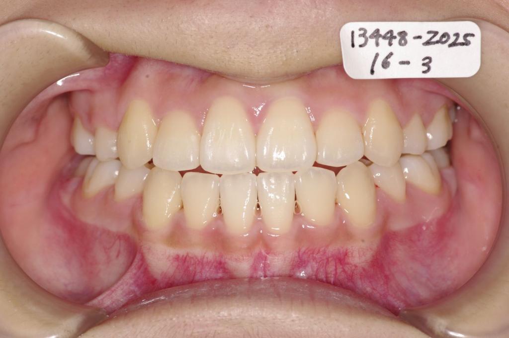 歯並び・咬み合わせ・八重歯・乱杭歯の矯正治療後口内写真NO.1232