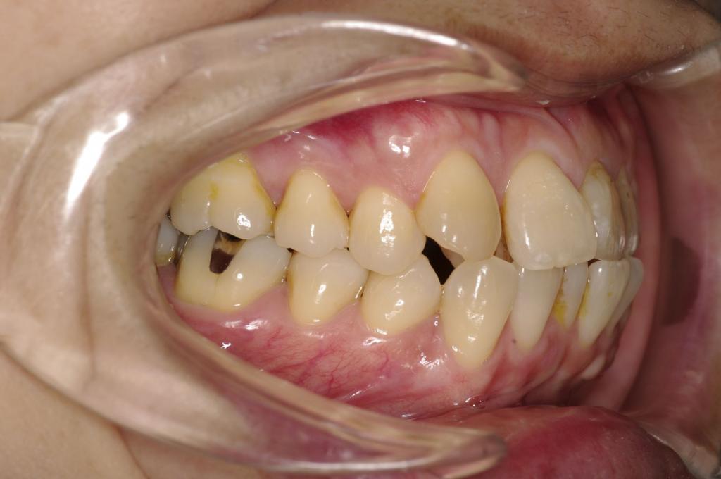 歯並び・咬み合わせ・八重歯・乱杭歯の矯正治療前口内写真NO.1233