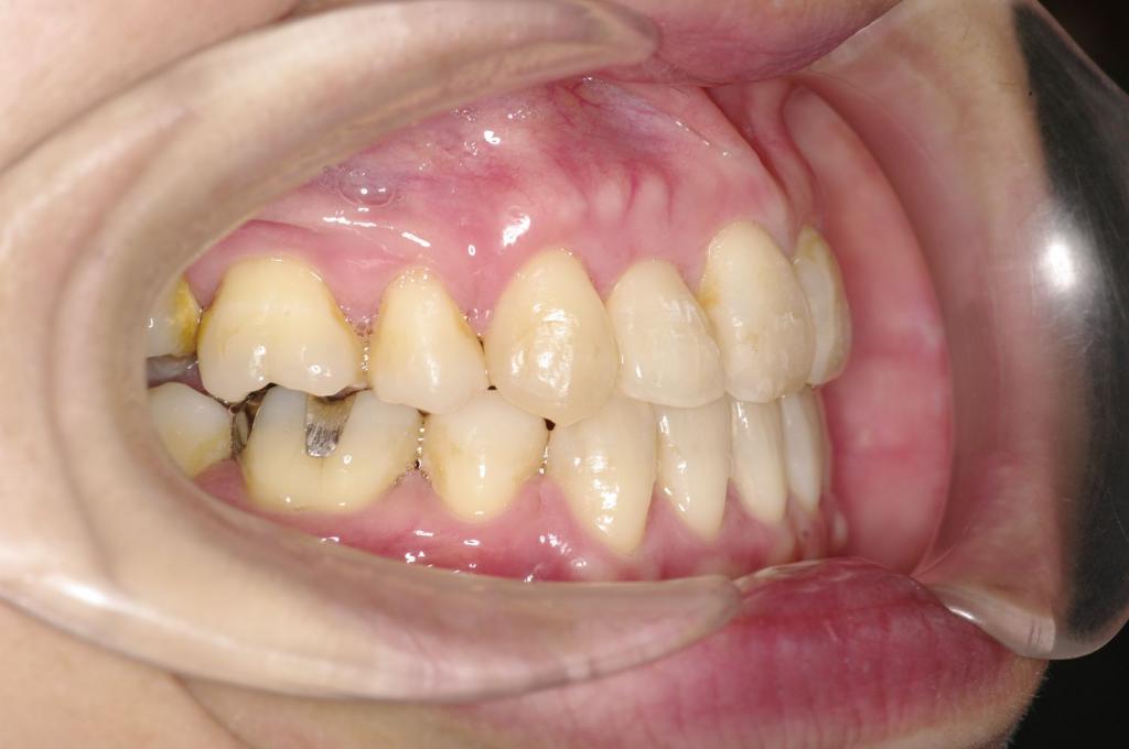 歯並び・咬み合わせ・八重歯・乱杭歯の矯正治療後口内写真NO.1233