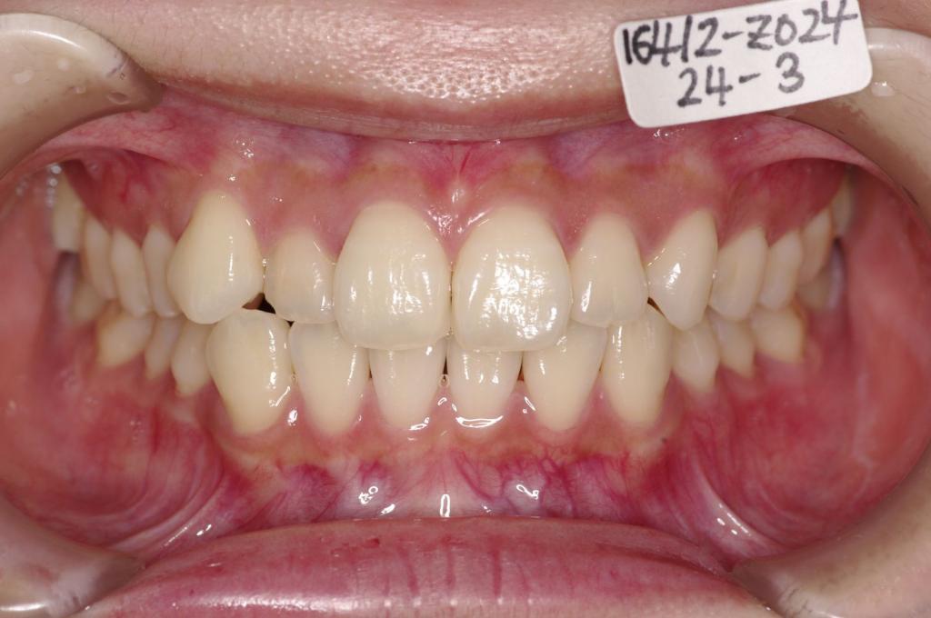 歯並び・咬み合わせ・八重歯・乱杭歯の矯正治療前口内写真NO.1234