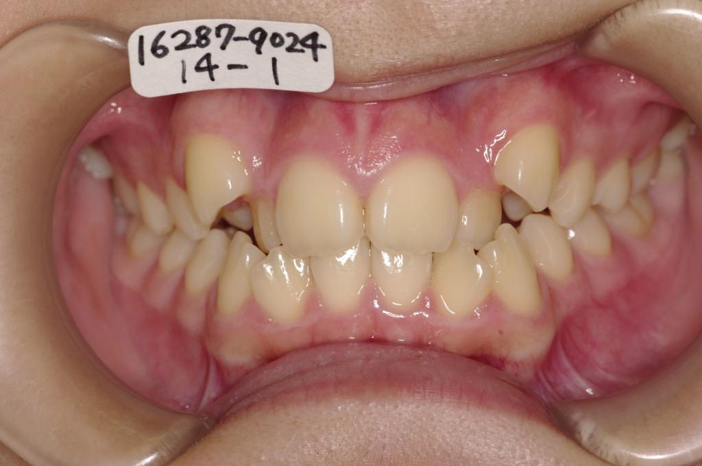 歯並び・咬み合わせ・八重歯・乱杭歯の矯正治療前口内写真NO.1235