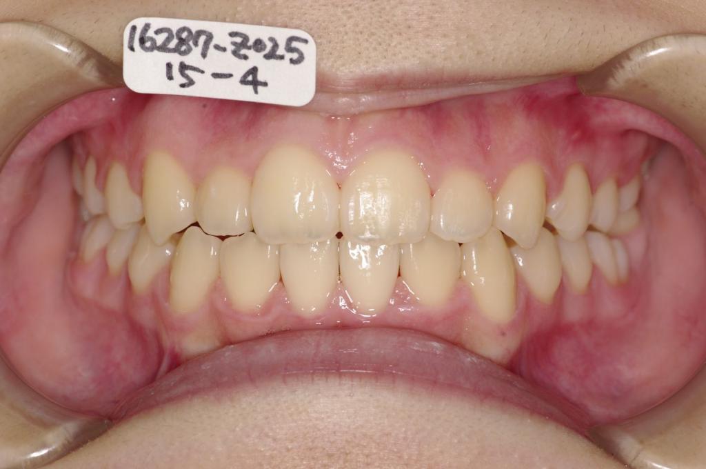 歯並び・咬み合わせ・八重歯・乱杭歯の矯正治療後口内写真NO.1235