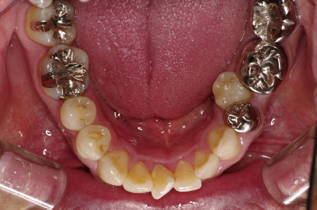 歯並び・咬み合わせ・八重歯・乱杭歯の矯正治療前口内写真NO.1236