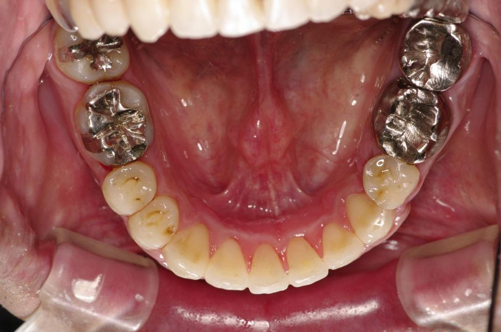 歯並び・咬み合わせ・八重歯・乱杭歯の矯正治療後口内写真NO.1236