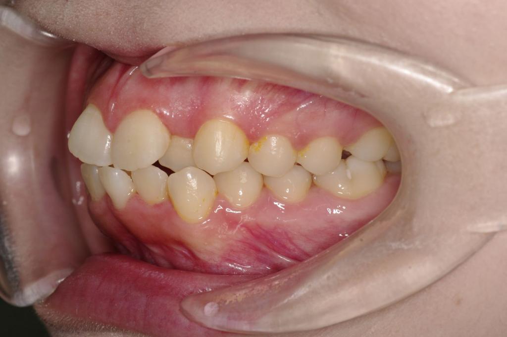 歯並び・咬み合わせ・八重歯・乱杭歯の矯正治療前口内写真NO.1237