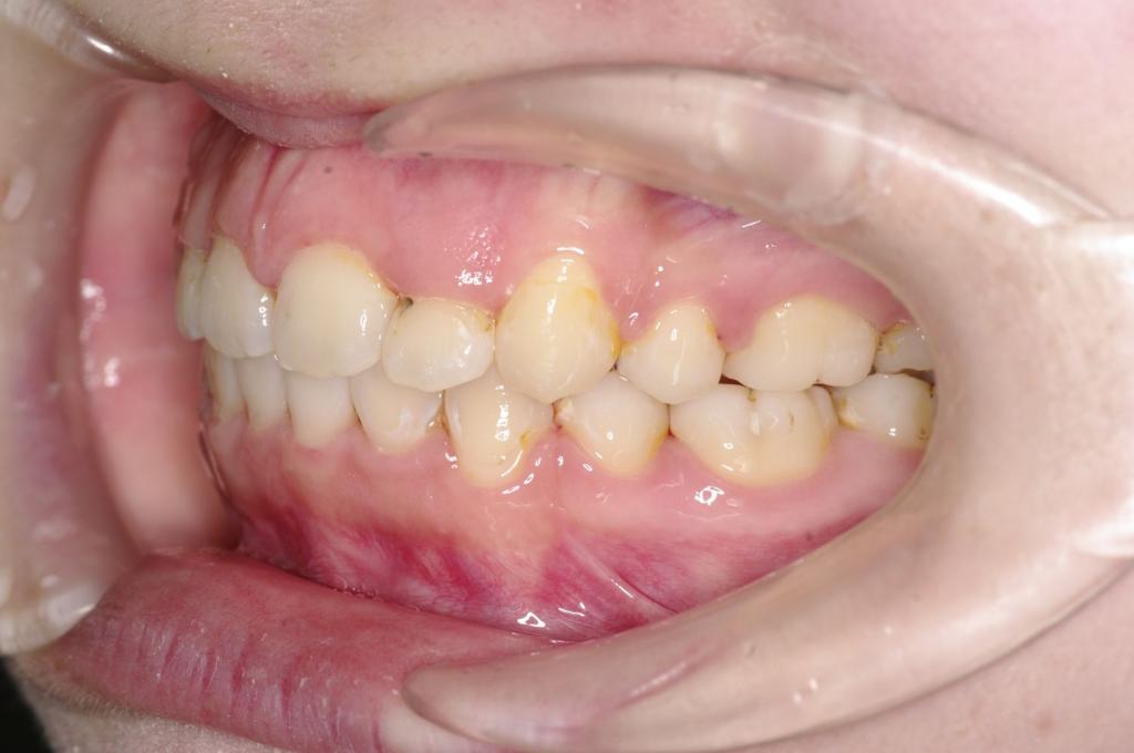 歯並び・咬み合わせ・八重歯・乱杭歯の矯正治療後口内写真NO.1237