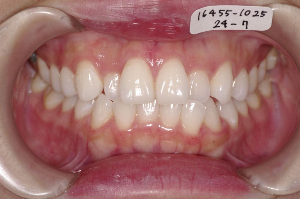 歯並び・咬み合わせ・八重歯・乱杭歯の矯正治療前口内写真NO.1238