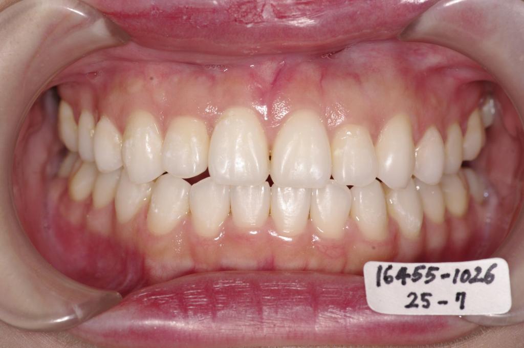 歯並び・咬み合わせ・八重歯・乱杭歯の矯正治療後口内写真NO.1238