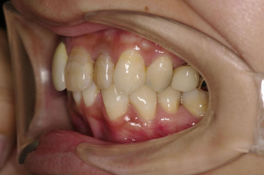 歯並び・咬み合わせ・八重歯・乱杭歯の矯正治療前口内写真NO.1239
