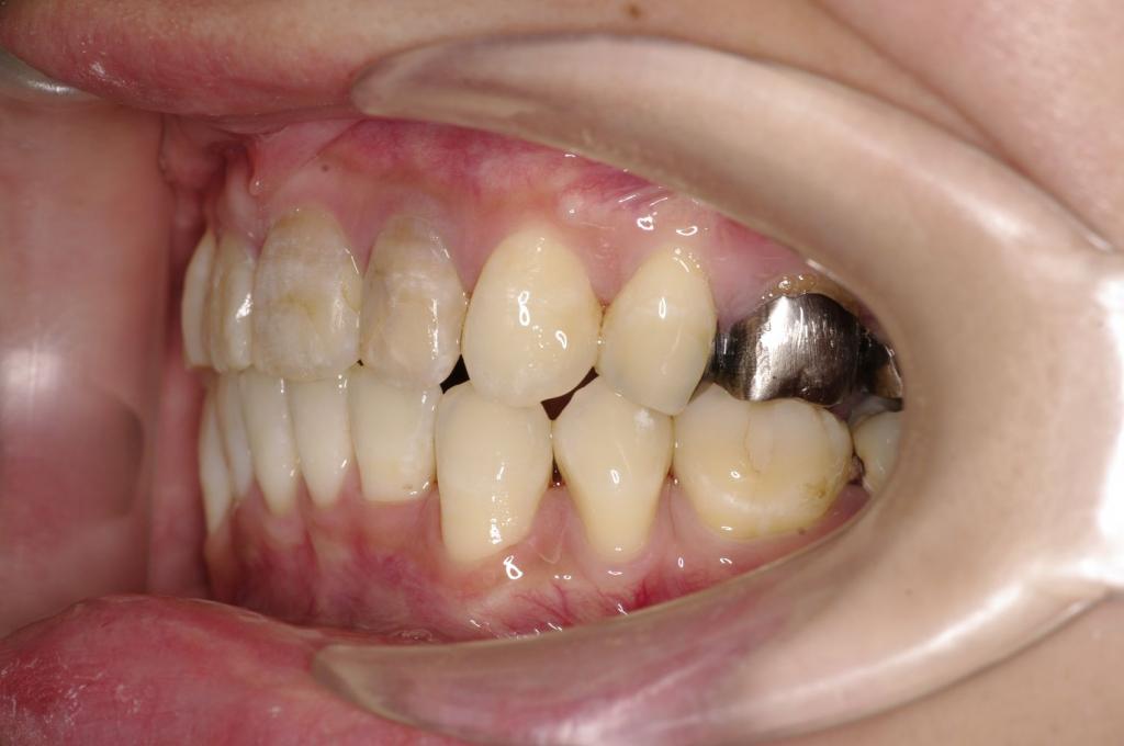 歯並び・咬み合わせ・八重歯・乱杭歯の矯正治療後口内写真NO.1239