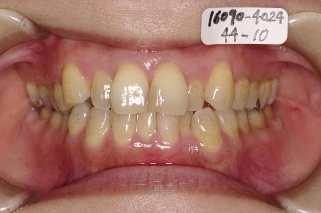 歯並び・咬み合わせ・八重歯・乱杭歯の矯正治療前口内写真NO.1240