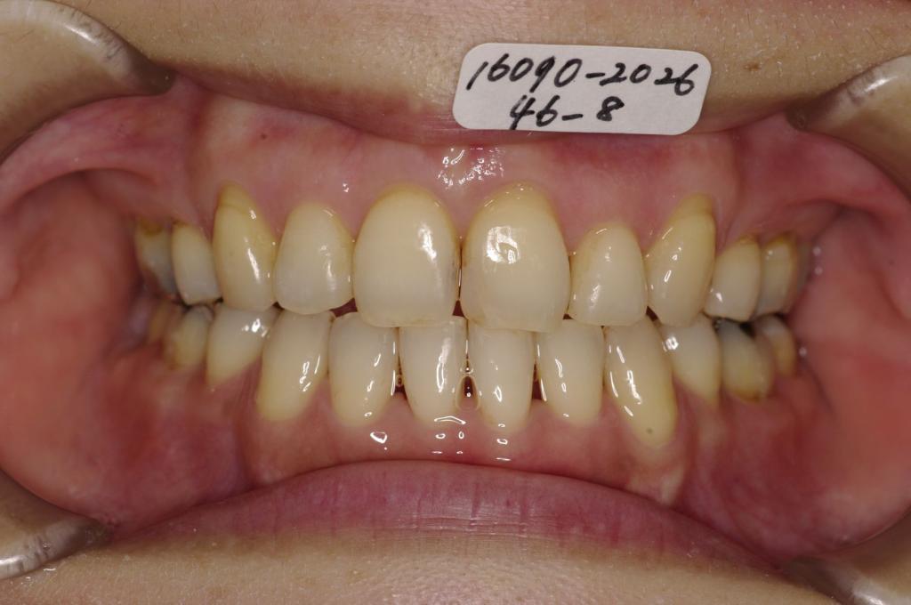 歯並び・咬み合わせ・八重歯・乱杭歯の矯正治療後口内写真NO.1240