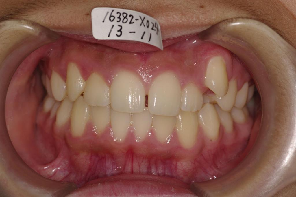 歯並び・咬み合わせ・八重歯・乱杭歯の矯正治療前口内写真NO.1241