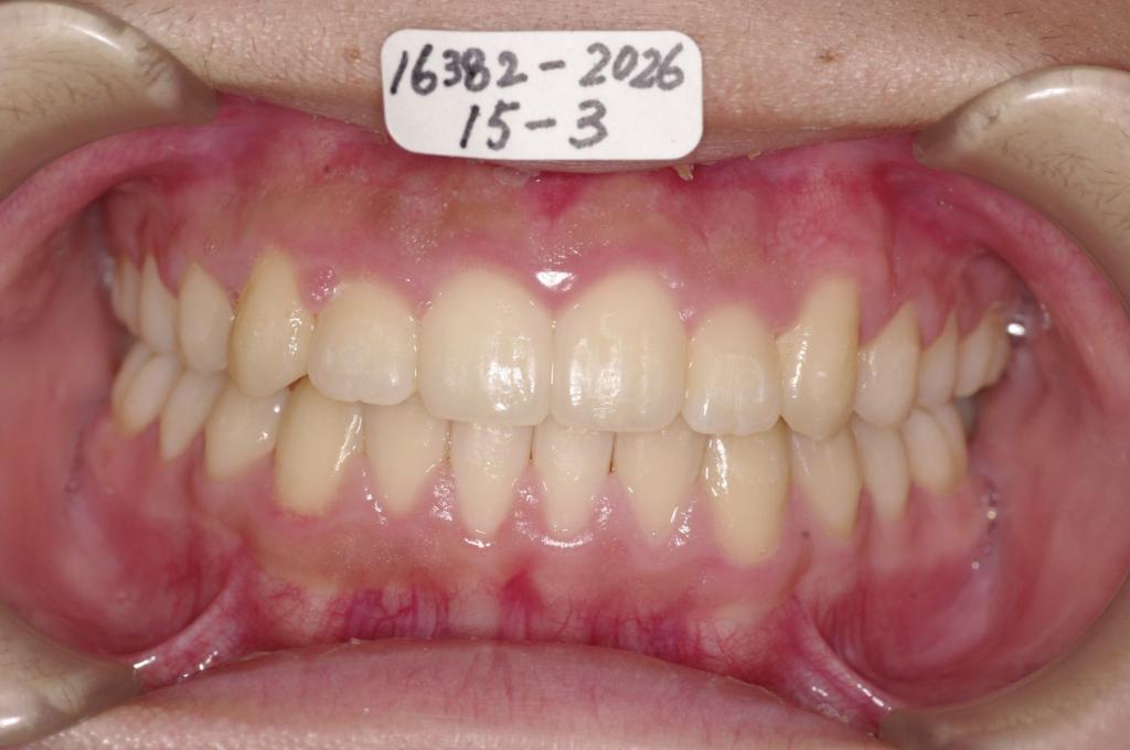 歯並び・咬み合わせ・八重歯・乱杭歯の矯正治療後口内写真NO.1241