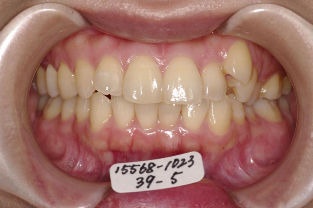 歯並び・咬み合わせ・八重歯・乱杭歯の矯正治療前口内写真NO.1242