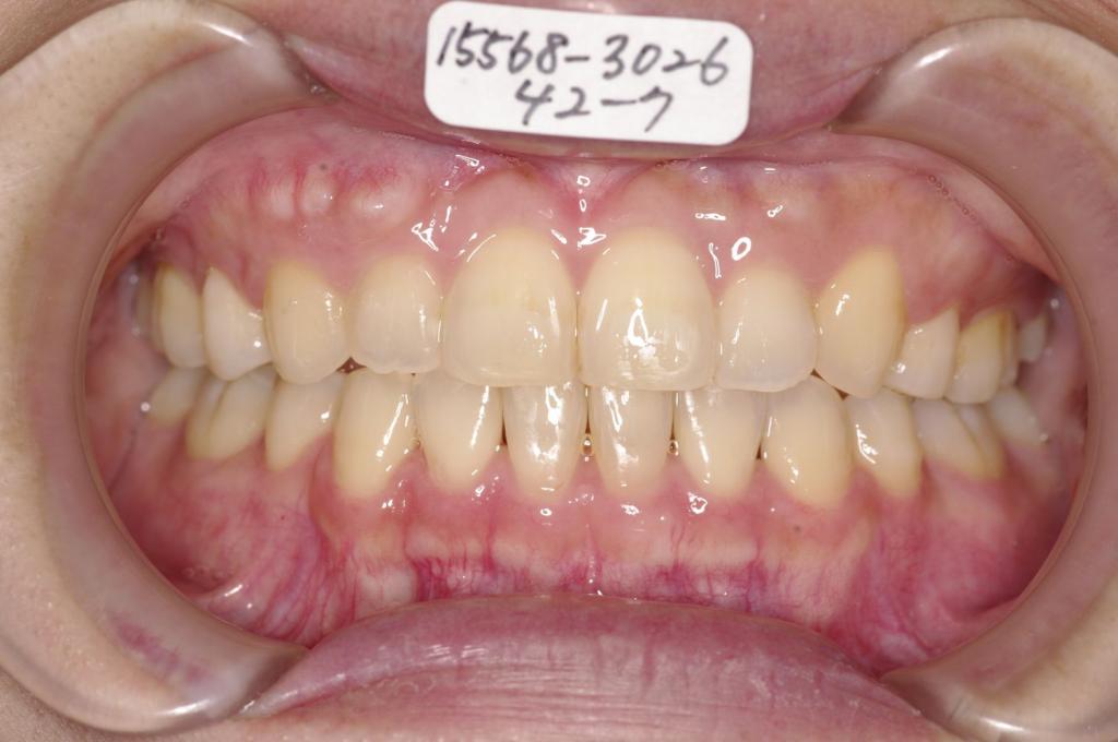 歯並び・咬み合わせ・八重歯・乱杭歯の矯正治療後口内写真NO.1242