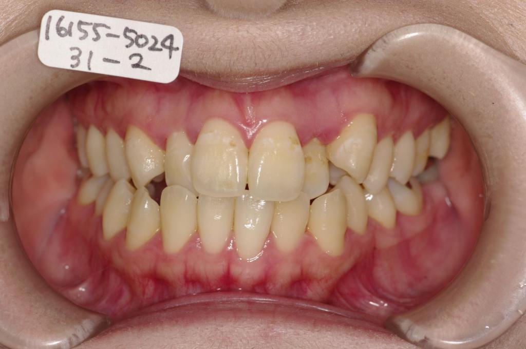 歯並び・咬み合わせ・八重歯・乱杭歯の矯正治療前口内写真NO.1243
