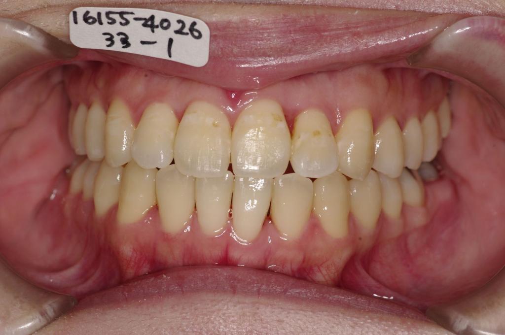 歯並び・咬み合わせ・八重歯・乱杭歯の矯正治療後口内写真NO.1243