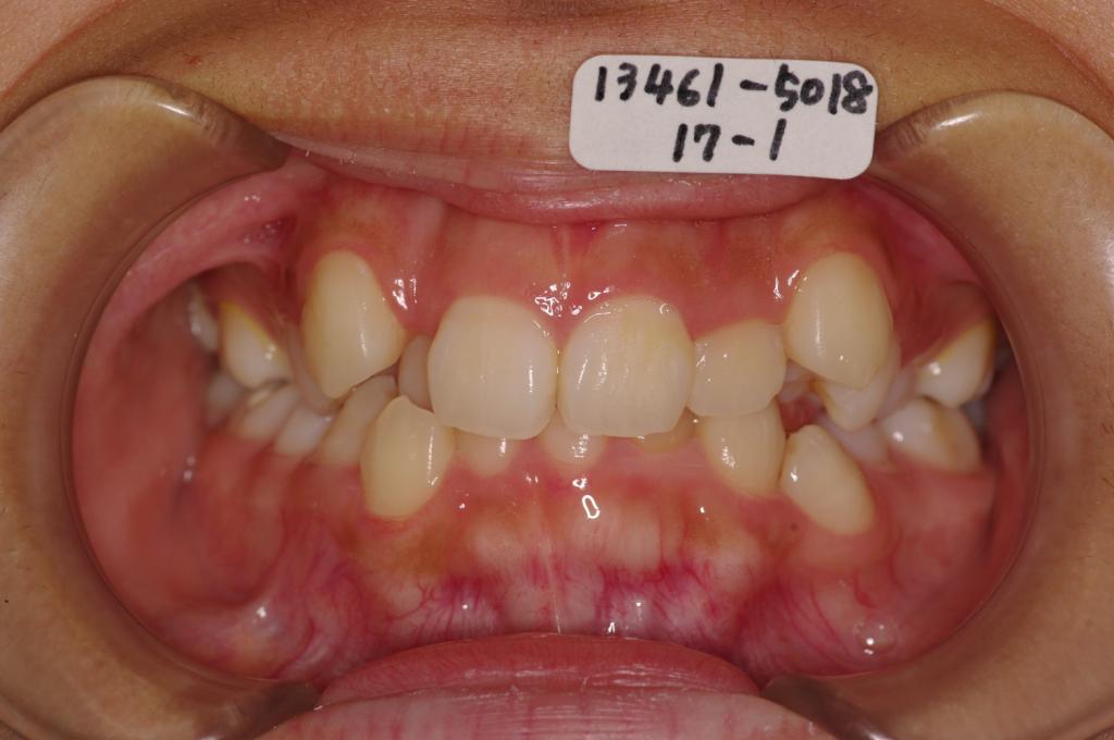 歯並び・咬み合わせ・八重歯・乱杭歯の矯正治療前口内写真NO.891