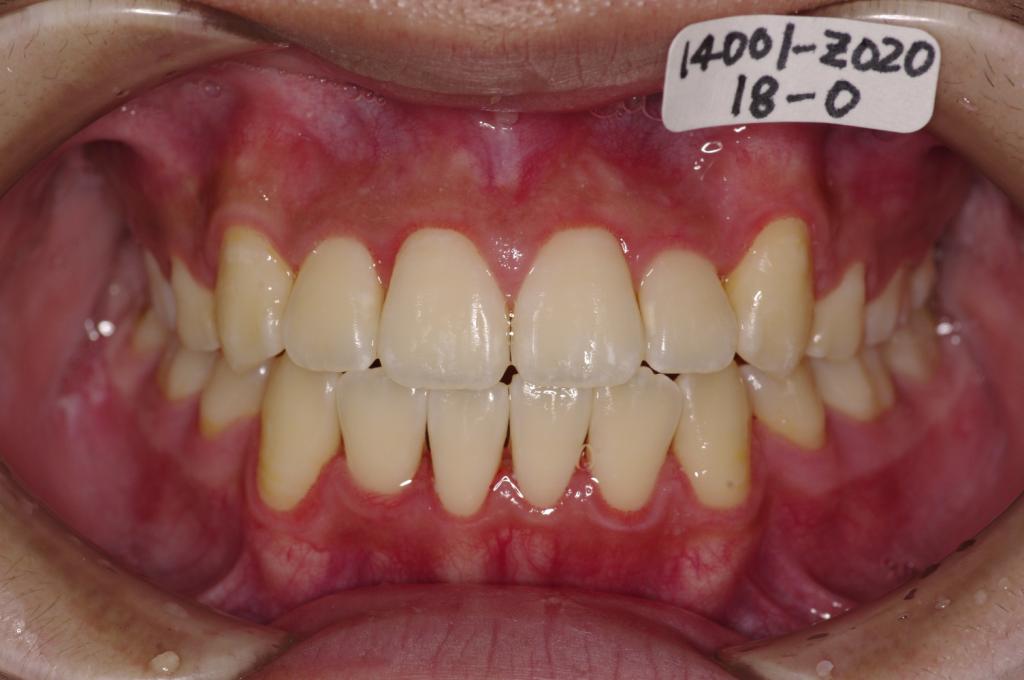 歯並び・咬み合わせ・八重歯・乱杭歯の矯正治療後口内写真NO.960