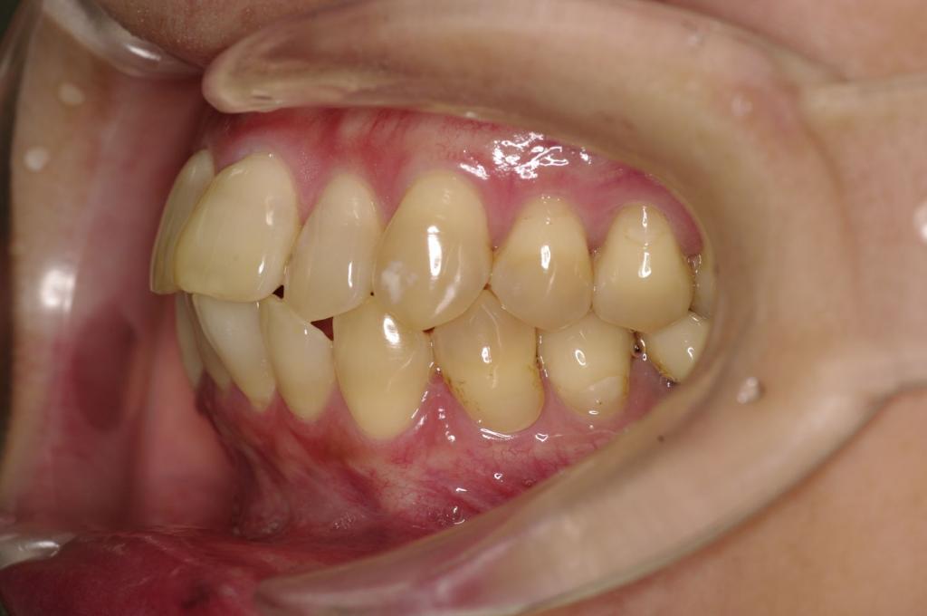 前歯、出っ歯・開咬の矯正治療前口内写真NO.1000
