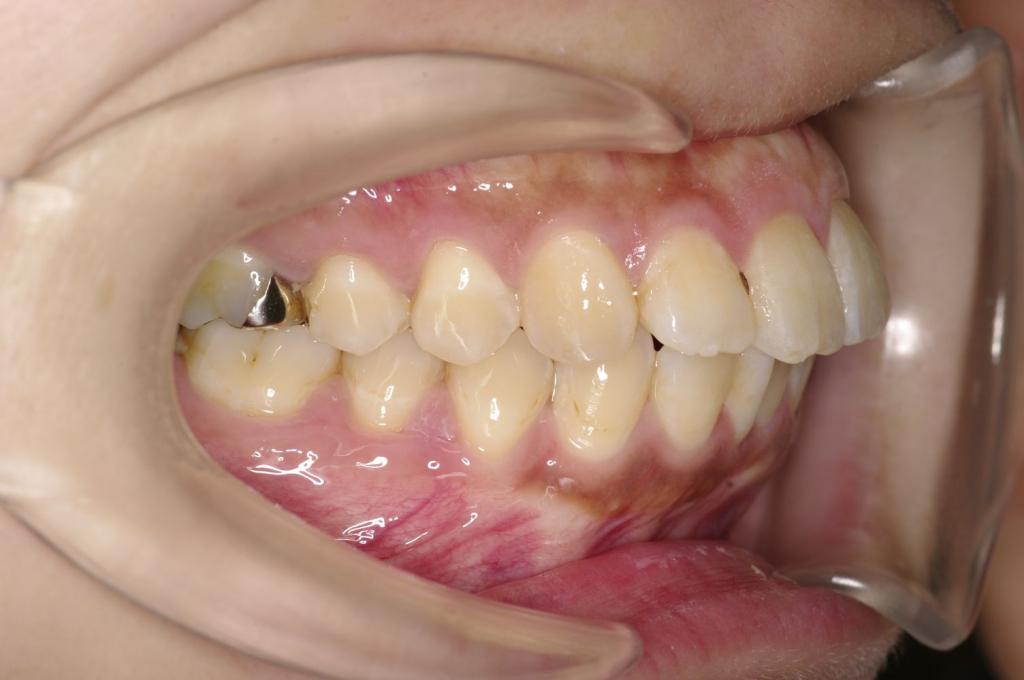 前歯、出っ歯・開咬の矯正治療前口内写真NO.1020