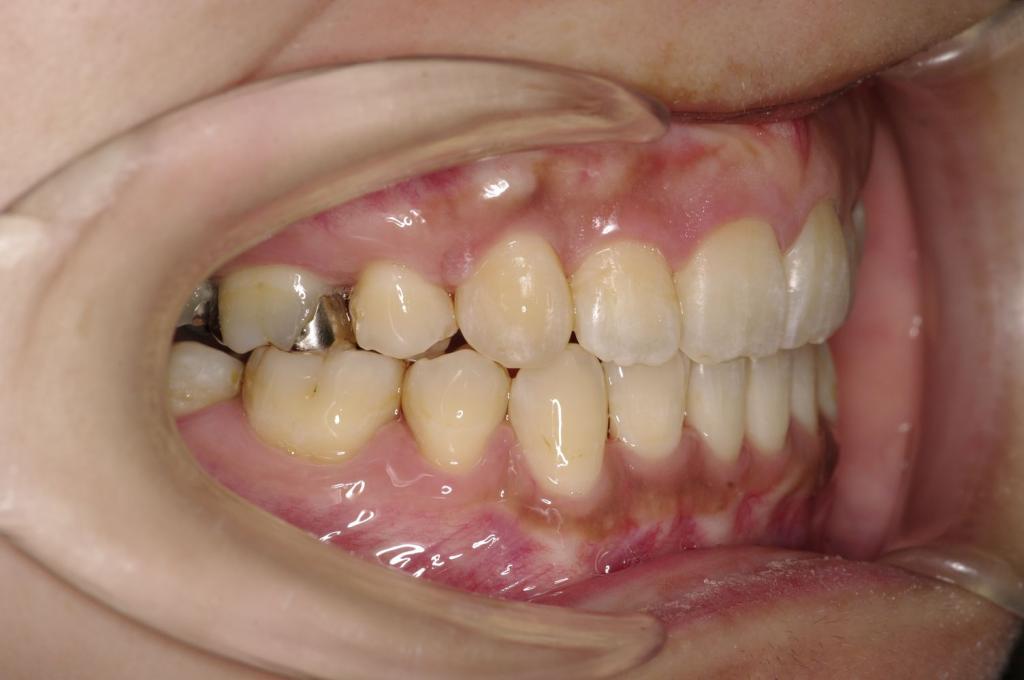 前歯、出っ歯・開咬の矯正治療後口内写真NO.1020