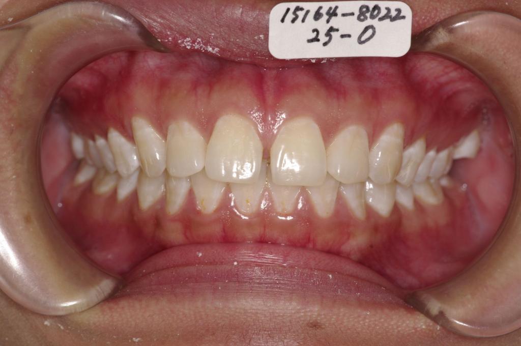前歯、出っ歯・開咬の矯正治療前口内写真NO.1021