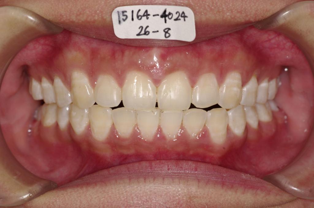 前歯、出っ歯・開咬の矯正治療後口内写真NO.1021