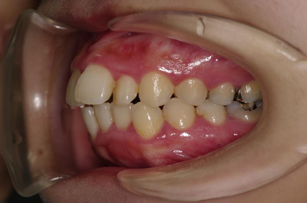 前歯、出っ歯・開咬の矯正治療前口内写真NO.1022