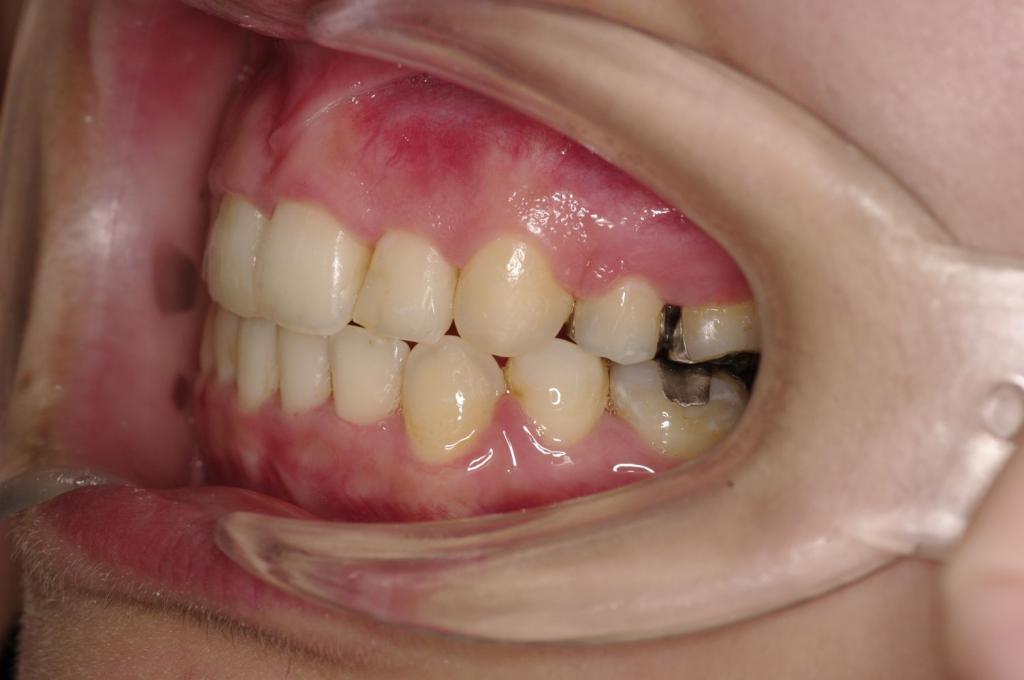 前歯、出っ歯・開咬の矯正治療後口内写真NO.1022