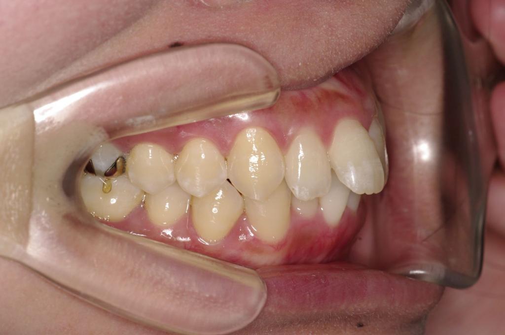 前歯、出っ歯・開咬の矯正治療前口内写真NO.1023