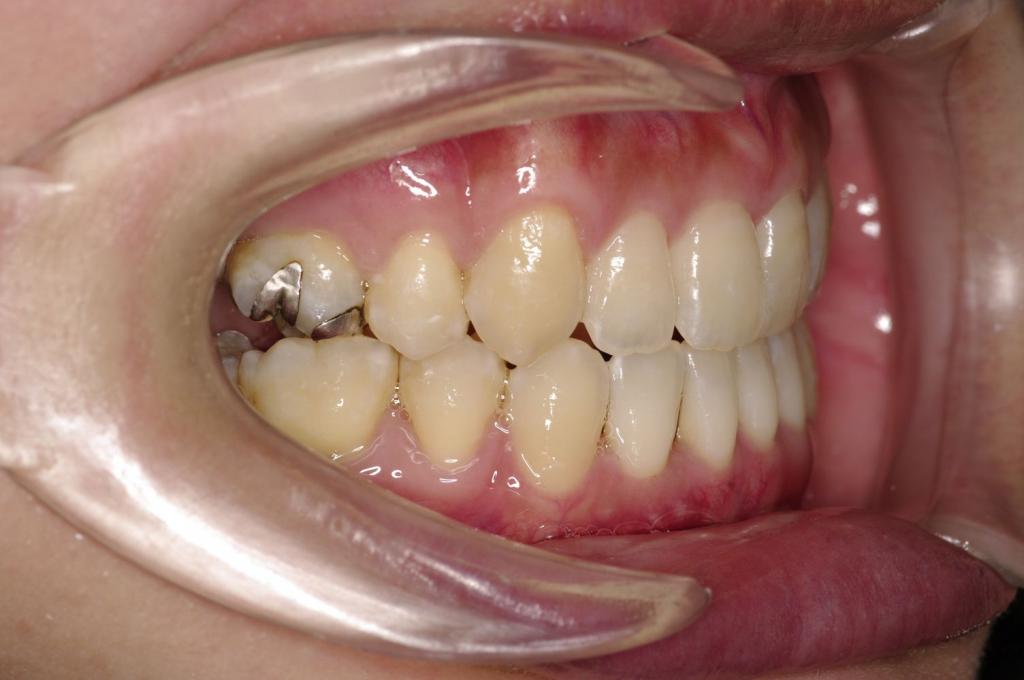 前歯、出っ歯・開咬の矯正治療後口内写真NO.1023
