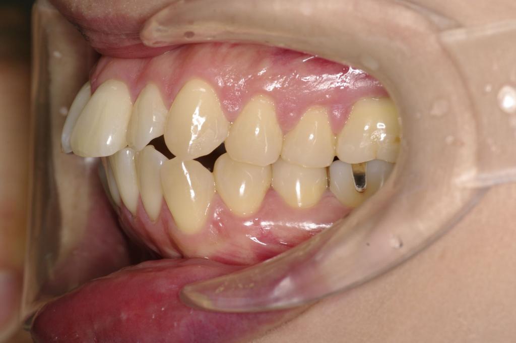 前歯、出っ歯・開咬の矯正治療前口内写真NO.1024
