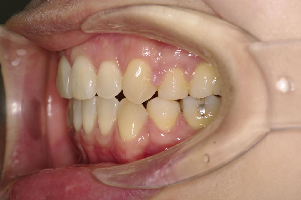 前歯、出っ歯・開咬の矯正治療後口内写真NO.1024