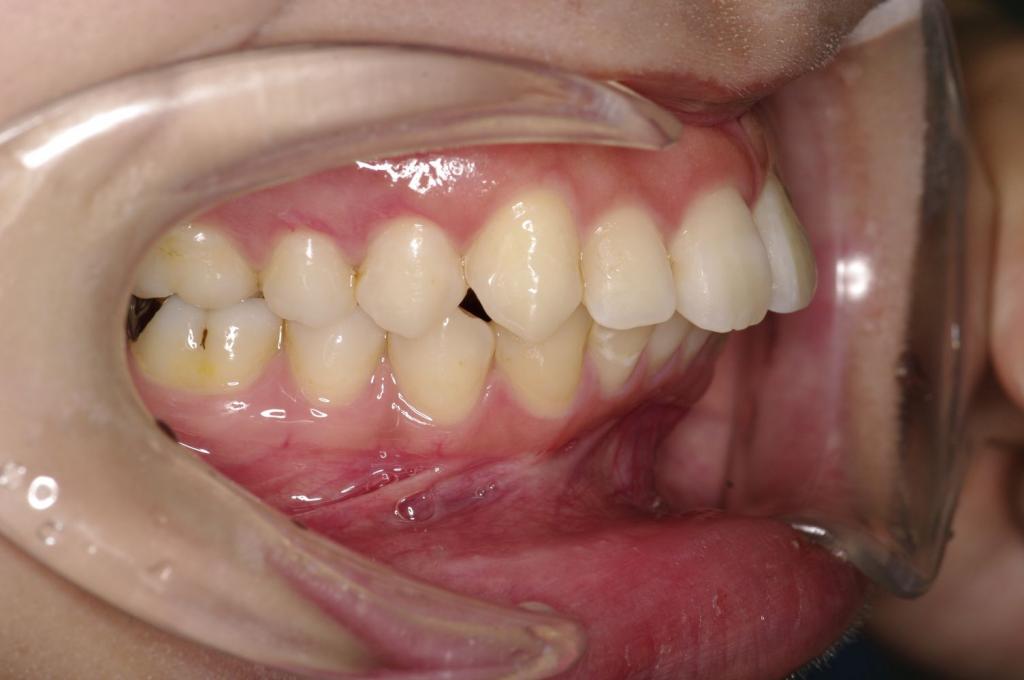 前歯、出っ歯・開咬の矯正治療前口内写真NO.1025