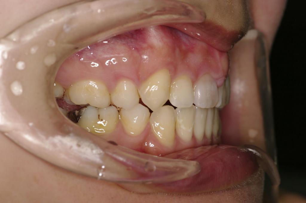 前歯、出っ歯・開咬の矯正治療後口内写真NO.1025