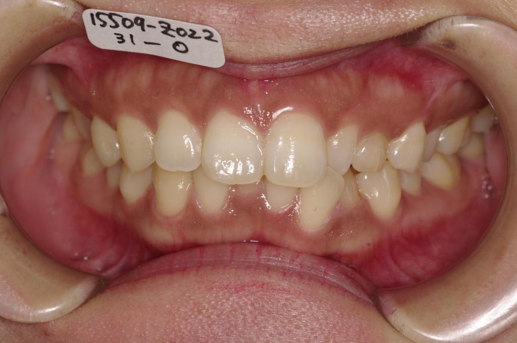 前歯、出っ歯・開咬の矯正治療前口内写真NO.1026