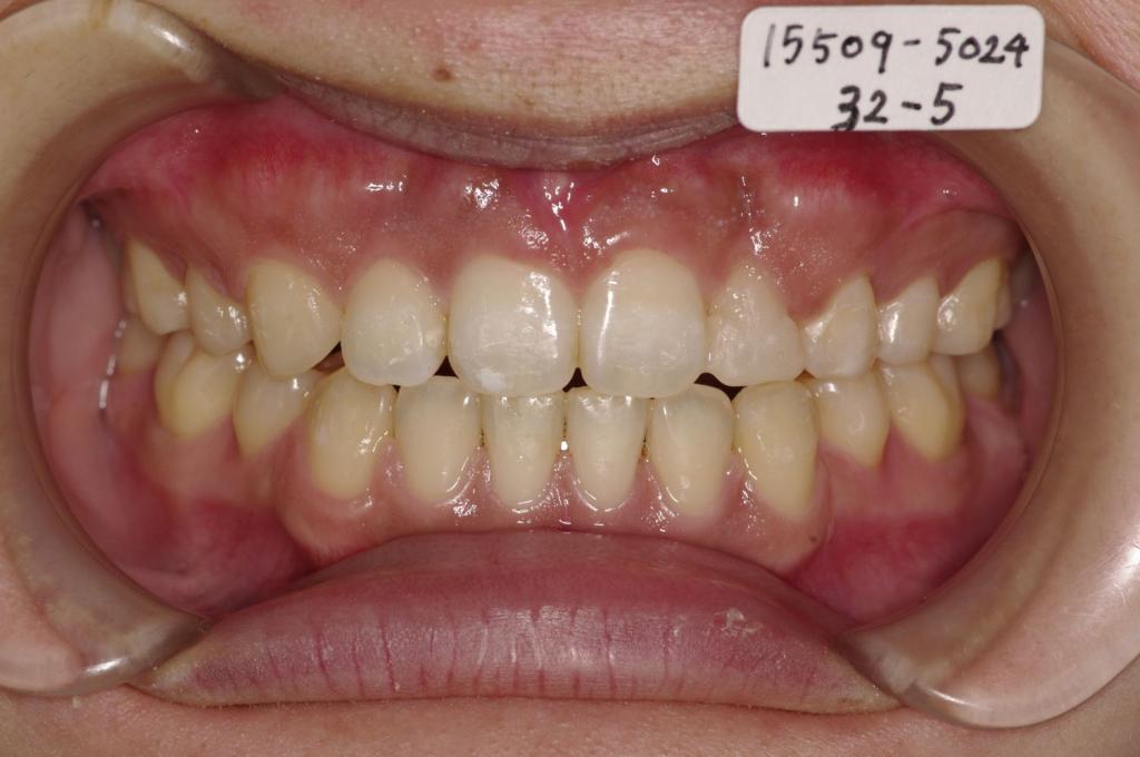前歯、出っ歯・開咬の矯正治療後口内写真NO.1026