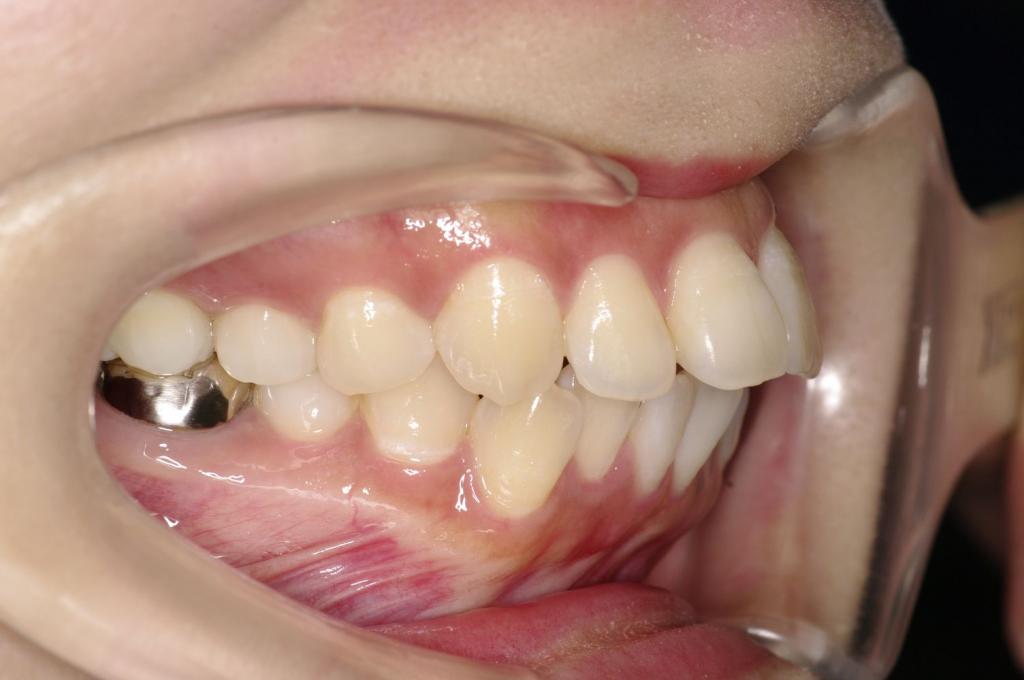 前歯、出っ歯・開咬の矯正治療前口内写真NO.1027